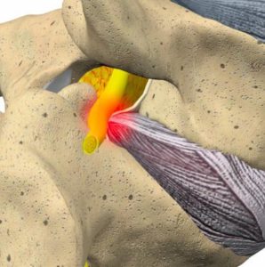 Sciatica or Radiculopathy